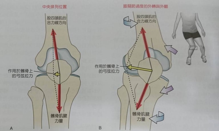 女生 q angle角度较大,影响股四头肌                    易造成髌骨