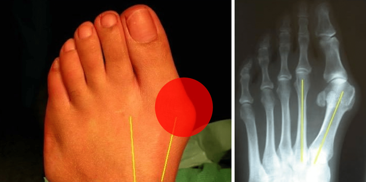 三个简单步骤减缓拇指外翻